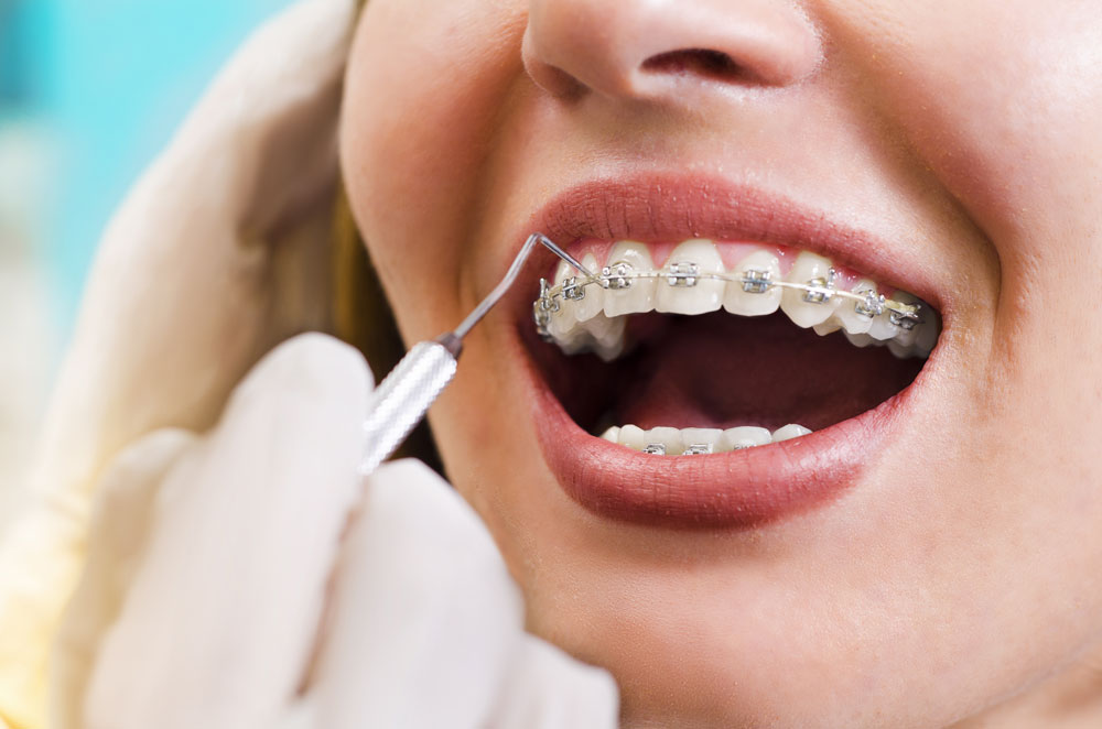 ortodonti-nedir-nasil-tedavi-edilir_20180226134509